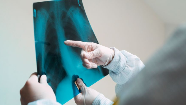 Tuberculose : les tests du nouveau traitement commencent